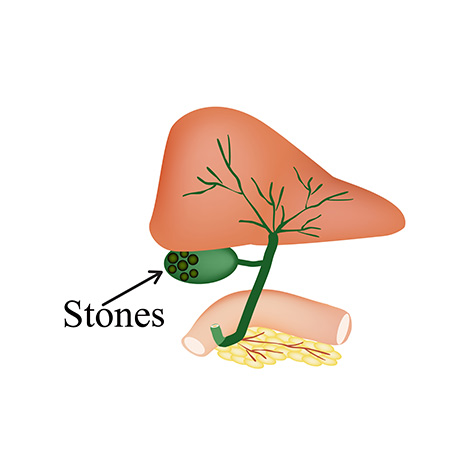 Gallbladder Symptoms and Indicators You May Not Be Aware Of