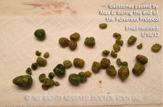 Pulverized Gallstones Max C