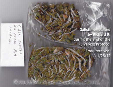 Gallstones passed by Richard R