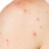 Akne is the Common Signal of Fatty Liver