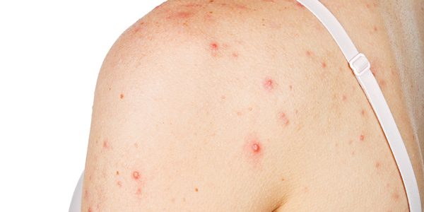 Acne is the Common Signal of Fatty Liver