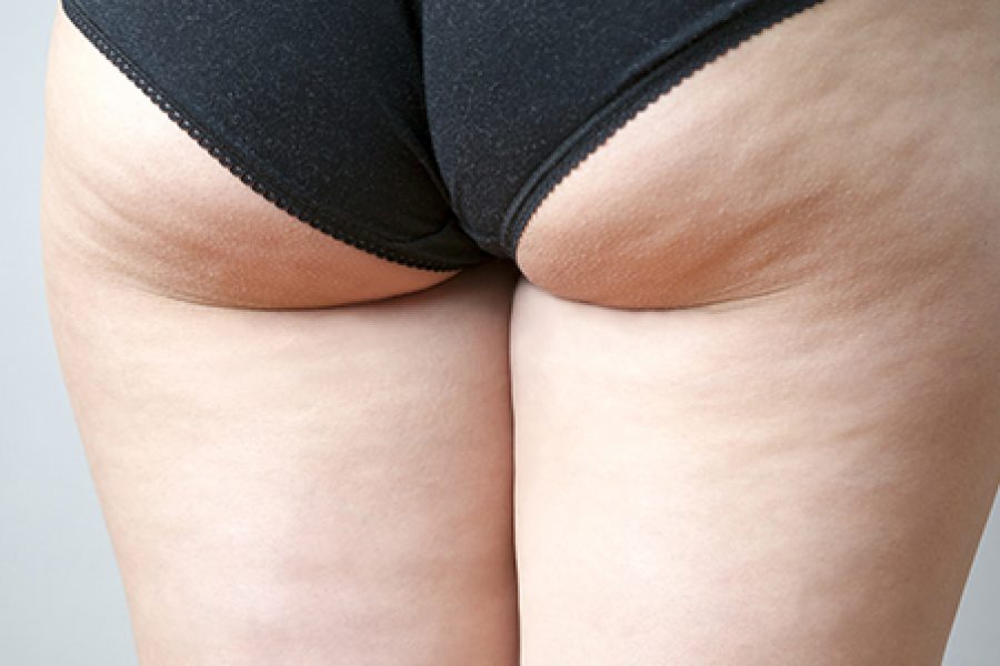Cellulite – Thighs