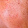 Facial Capillaries Could Be a Signal of Fatty Liver