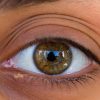 Fatty Liver Disease Symptoms: Lumps of Fat Under the Eyelids