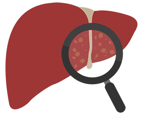 Gallbladder Pain: Gallstones in the Liver