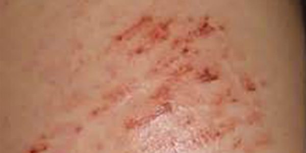 Skin Rashes Can Be a Fatty Liver Symptom