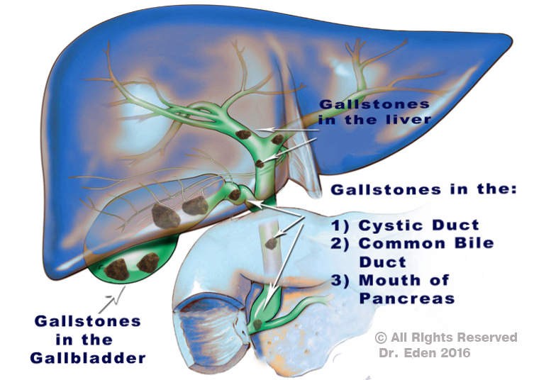 Gallstones Cause | Gallbladder Stones | Signs of Gallbladder Symptoms