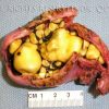 Dissected Gallbladder with Cholesterol Gallstones