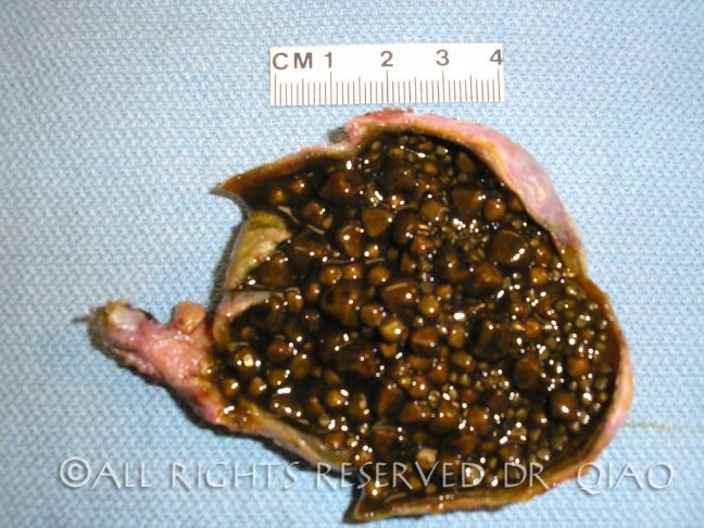 gallbladder_and_gallstones_dissected